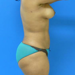 Patient # 97623 After Photo # 6