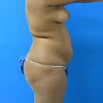 Patient # 97623 Before Photo # 5