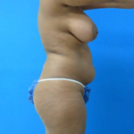 Patient # 59133 Before Photo # 5