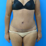 Patient # 81557 After Photo # 2