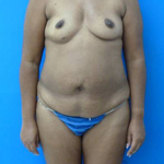 Patient # 81557 Before Photo # 1