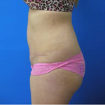 Patient # 49876 After Photo # 4