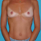 Patient # 46502 Before Photo # 1