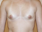 Patient # 13625 Before Photo # 1