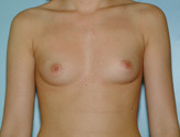 Patient # 95273 Before Photo # 1