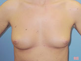 Patient # 56573 Before Photo # 1