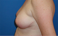 Patient # 28436 After Photo # 4