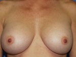 Patient # 22450 After Photo # 2