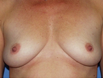 Patient # 22450 Before Photo # 1