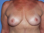 Patient # 34261 After Photo # 2
