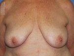 Patient # 34261 Before Photo # 1