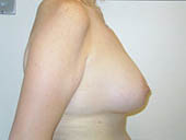 Patient # 85565 After Photo # 4