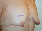 Patient # 85565 Before Photo # 1