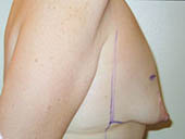 Patient # 85565 Before Photo # 3