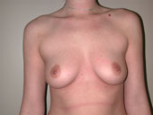 Patient # 14459 Before Photo # 1