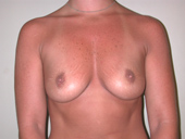 Patient # 61264 Before Photo # 1