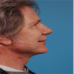 Patient # 14452 After Photo # 2