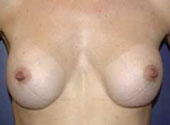 Patient # 87881 After Photo # 2