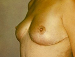 Patient # 29963 After Photo # 2