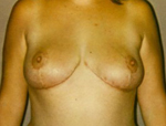 Patient # 21254 After Photo # 2