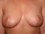 Patient # 58142 After Photo # 2