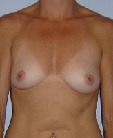 Patient # 74373 Before Photo # 1