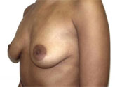 Patient # 18188 Before Photo # 1