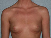 Patient # 74583 Before Photo # 1
