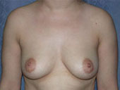 Patient # 99398 Before Photo # 1