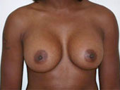 Patient # 47630 After Photo # 2