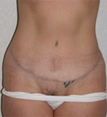 Patient # 43655 After Photo # 2