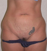 Patient # 43655 Before Photo # 1