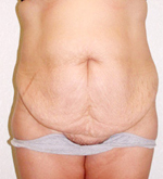 Patient # 41426 Before Photo # 1