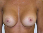 Patient # 78586 After Photo # 2