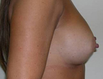 Patient # 78586 After Photo # 4