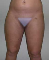 Patient # 50458 After Photo # 2