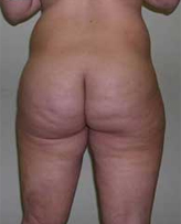 Patient # 50458 After Photo # 4