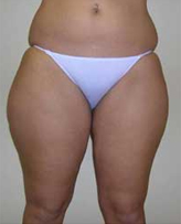 Patient # 50458 Before Photo # 1
