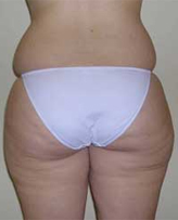 Patient # 50458 Before Photo # 3