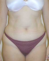 Patient # 92378 Before Photo # 1