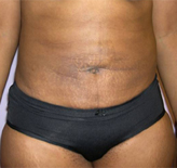 Patient # 49757 After Photo # 2