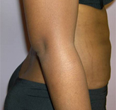Patient # 49757 After Photo # 4