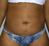 Patient # 49757 Before Photo # 1