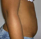 Patient # 49757 Before Photo # 3