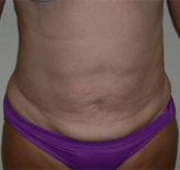 Patient # 84799 After Photo # 2