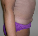 Patient # 84799 After Photo # 4