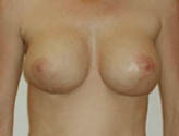 Patient # 35336 After Photo # 2