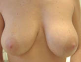 Patient # 35336 Before Photo # 1