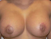 Patient # 11527 After Photo # 2