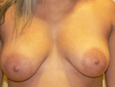 Patient # 11527 Before Photo # 1
